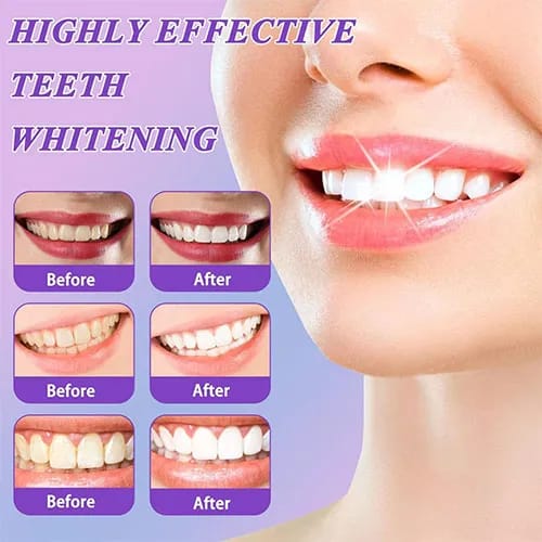 Hismile V34 Purple Color Corrector Serum – Advanced Teeth Whitening Toothpaste